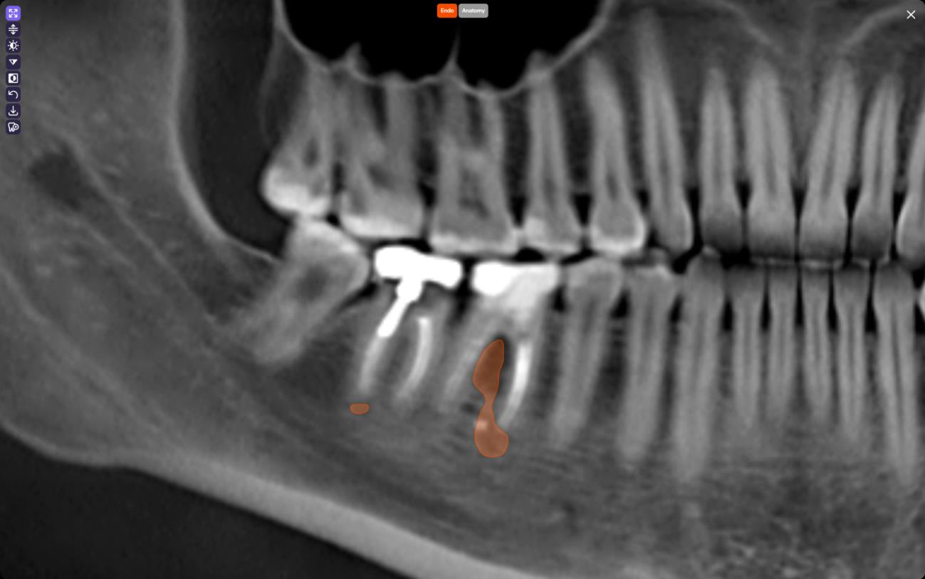CBCT panoramic reconstruction in Diagnocat with an AI overlay highlighting a suspected periapical radiolucency at tooth #30 in the lower right quadrant.