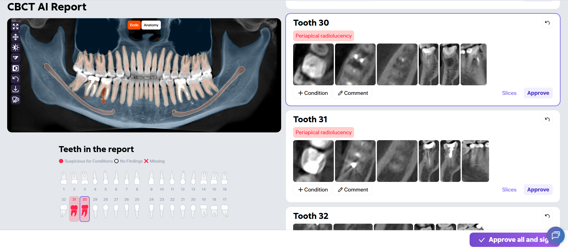 Diagnocat CBCT AI Report interface: a panoramic view, a color-coded tooth chart marking teeth 30 and 31 as suspicious, and per-tooth report cards flagging periapical radiolucency.
