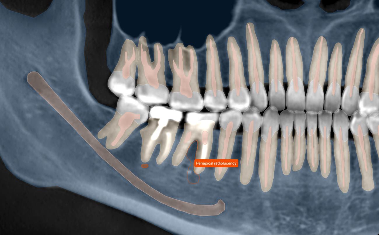 Diagnocat 3D Viewer showing segmented, color-coded maxillofacial anatomy with a periapical radiolucency tag near the roots of tooth #30.