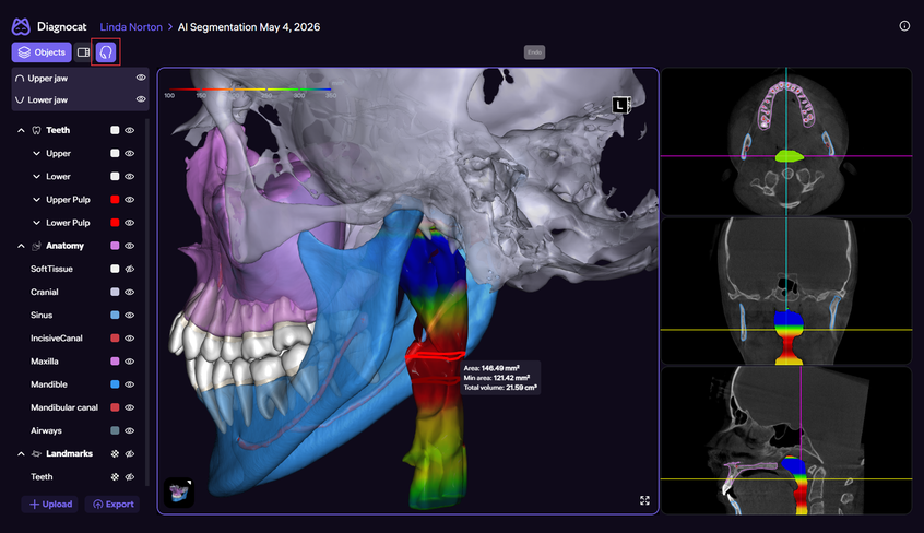 3D airway volume analysis in the Diagnocat 3D Report with a color-coded airway lumen